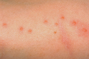 Bed Bug Bites